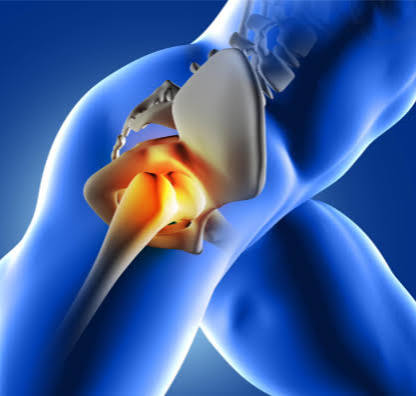 Radiating hip pain, where chronic hip pain and FAI are felt