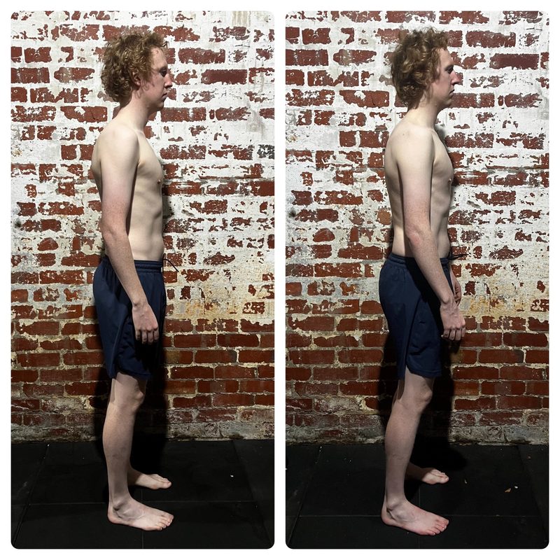 Charles right side — reduced anterior pelvic tilt
